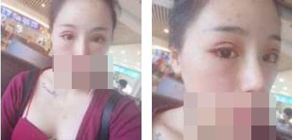 寧波美仁整形美容醫(yī)院李英大醫(yī)生做切開雙眼皮效果怎么樣？