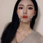 蘇州愛(ài)思特醫(yī)療美容醫(yī)院翟奔宇醫(yī)生肋軟骨隆鼻案例效果對(duì)比圖