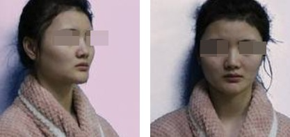 上海新健威醫(yī)療整形醫(yī)生錢成寶做肋軟骨隆鼻+自體脂肪全臉填充案例