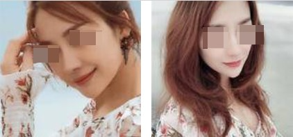 上海攸維醫(yī)療美容診所整形醫(yī)生李靜做膨體隆鼻效果怎么樣？附案例展示