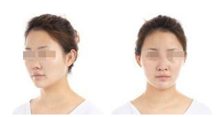 蘭州美月整形美容醫(yī)院文輝才醫(yī)生做鼻綜合整形效果怎么樣？附鼻綜合案例