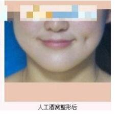 德州市第二人民醫(yī)院燒傷美容整形科張波濤醫(yī)生做酒窩成形術(shù)怎么樣？
