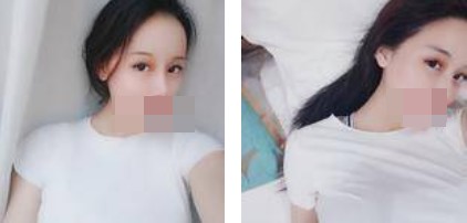 寧波美仁整形美容醫(yī)院李英大醫(yī)生做切開雙眼皮效果怎么樣？