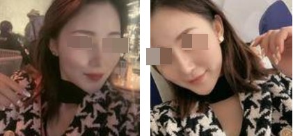 術后照片
