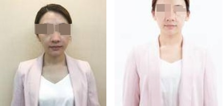 上海攸維醫(yī)療美容診所整形醫(yī)生李靜做膨體隆鼻效果怎么樣？附案例展示