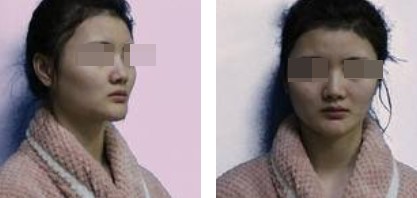 上海新健威醫(yī)療整形醫(yī)生錢成寶做肋軟骨隆鼻+自體脂肪全臉填充案例