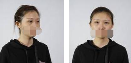 沒(méi)有了眼袋困擾，身體和心態(tài)都年輕了十歲
