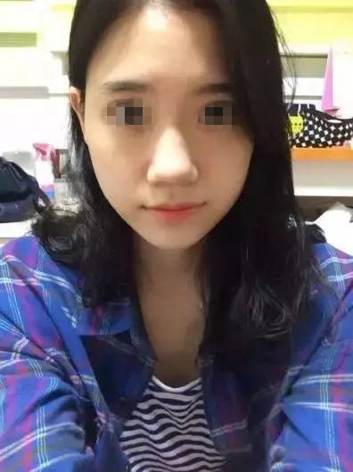 做完膨體隆鼻，鼻子變“挺”了