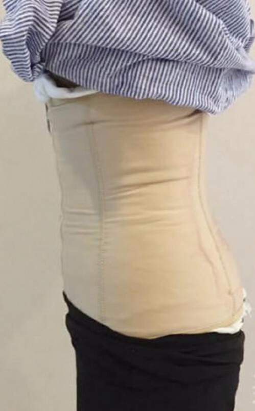 合肥壹加壹整形醫(yī)生周福田做腰腹吸脂技術(shù)怎么樣？附腰腹吸脂案例