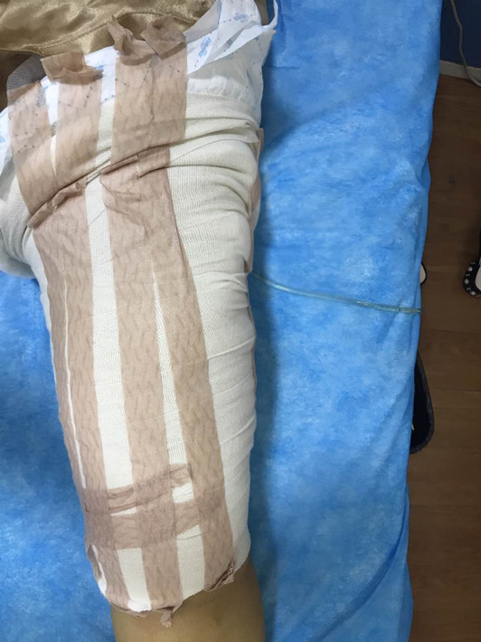 廣州軍頤醫(yī)院整形美容中心石建薇醫(yī)生腰腹吸脂真實(shí)案例對比圖