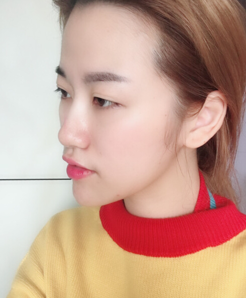 成都藝星陳遠(yuǎn)琨醫(yī)生注射肉毒素瘦臉效果案例對比圖