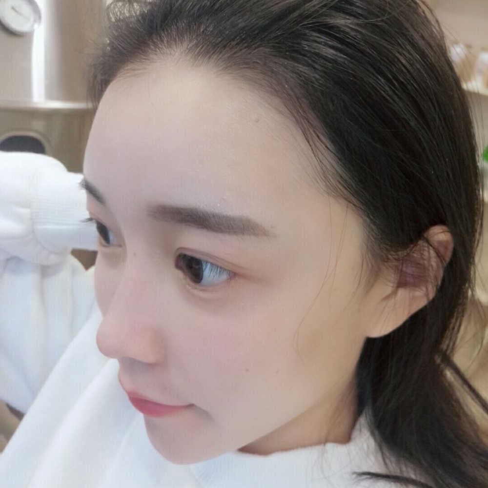 山西伊特雅整形醫(yī)生王鳳芹自體脂肪豐面頰+V-LINE瓜子臉手術案例效果圖