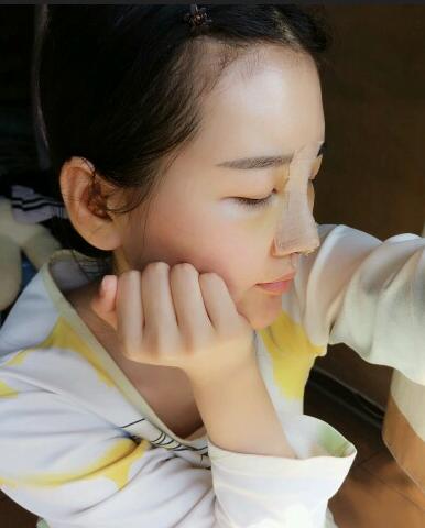 漢中韓美整形醫(yī)生常雙模假體隆鼻+耳軟骨墊鼻尖真實案例效果圖