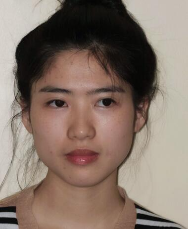 北京彤美整形醫(yī)院趙彤醫(yī)生做下頜角整形怎么樣？下頜角整形案例展示