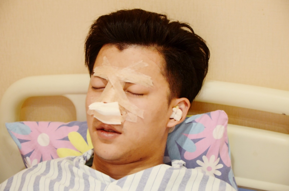 濟寧名美醫(yī)療整形醫(yī)生李唯少假體隆鼻+耳軟骨墊鼻尖真實案例效果對比圖
