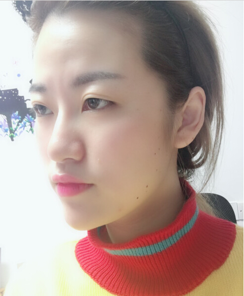 成都藝星醫(yī)療美容醫(yī)院陳遠(yuǎn)琨醫(yī)生做注射肉毒素瘦臉效果怎么樣？附案例