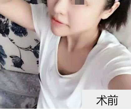 深圳博美整形醫(yī)生劉超做自體脂肪隆胸怎么樣？自體脂肪隆胸案例