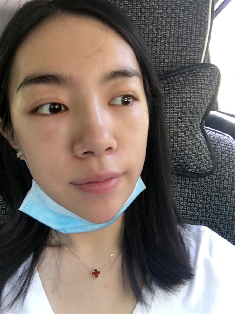 合肥壹加壹整形美容醫(yī)院做祛眼袋效果怎么樣？金大生祛眼袋案例分享