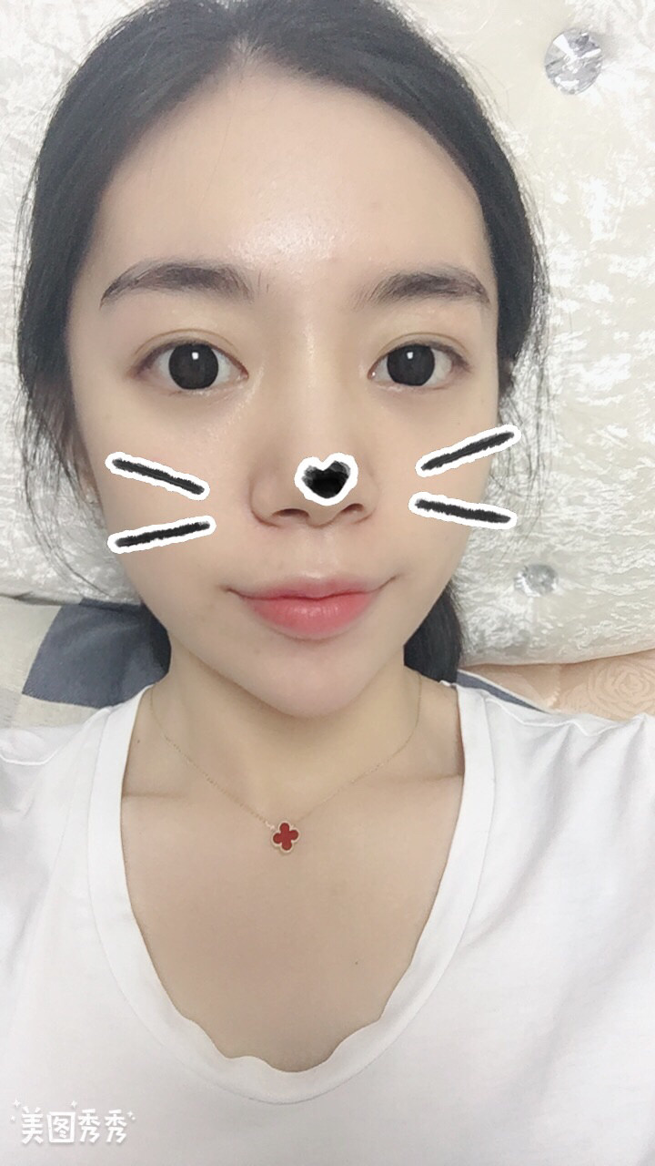 做完祛眼袋手術(shù)28天