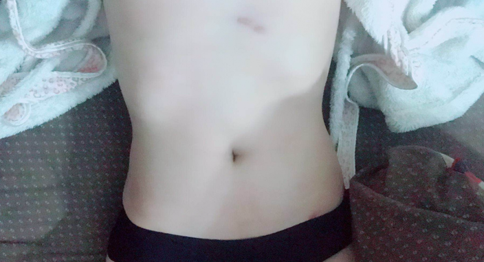 深圳晨曦整形醫(yī)院吉米斯做腰腹吸脂怎么樣？附吉米斯醫(yī)生腰腹吸脂案例