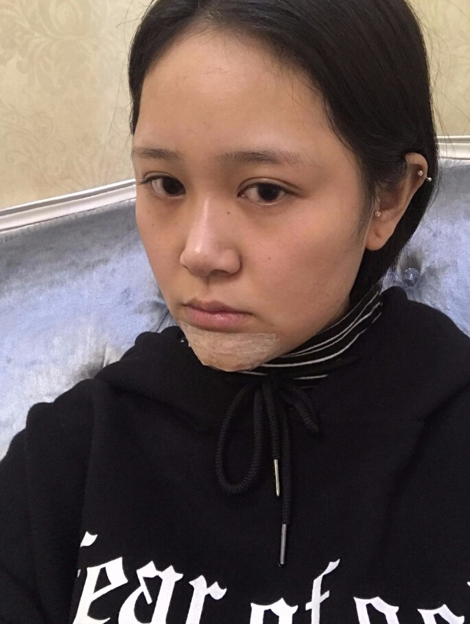 青島集美整形醫(yī)院做硅膠墊下巴怎么樣？趙煜楠醫(yī)生硅膠墊下巴真人案例