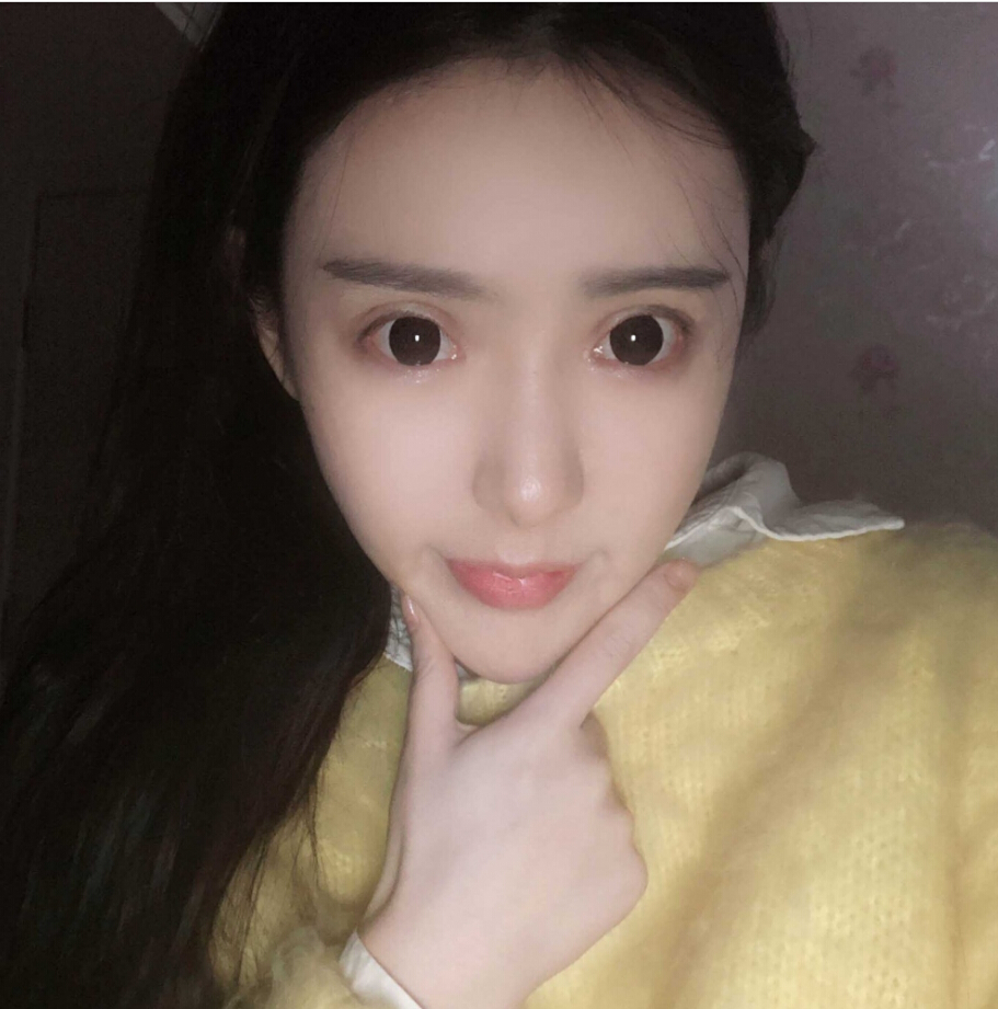 重慶柏漫醫(yī)療美容診所高紅艷醫(yī)生做面部吸脂怎么樣？面部吸脂案例分享