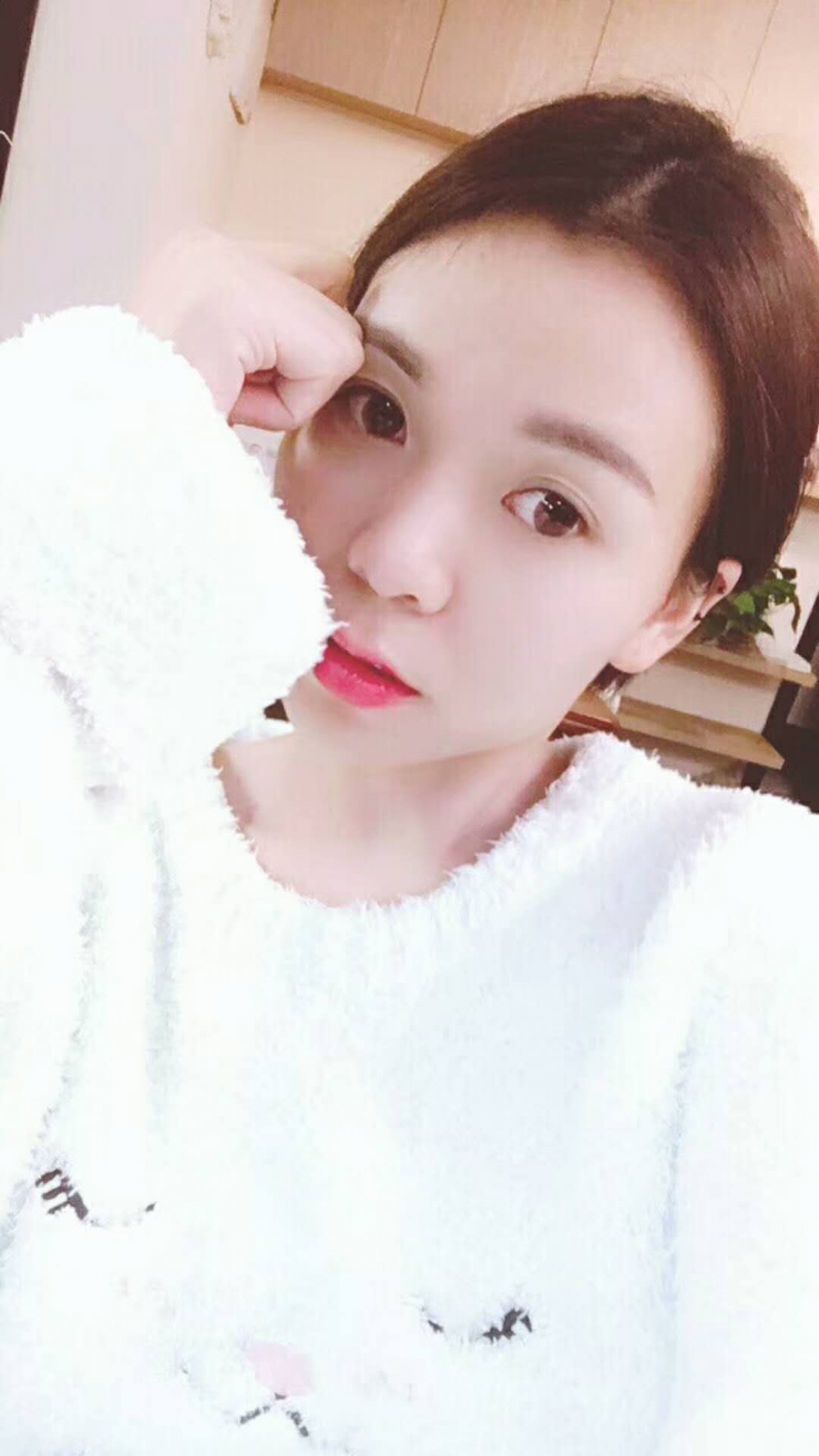 長沙星雅醫(yī)療美容醫(yī)院做埋線提升去法令紋效果怎么樣？附金振玉醫(yī)生案例