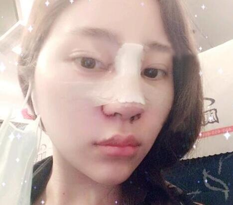 蘇州明基醫(yī)院醫(yī)療美容科做鼻綜合整形怎么樣？蘇州明基鼻綜合整形案例