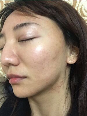重慶柏漫醫(yī)療美容診所做激光祛痘效果怎么樣？白亞亞激光祛痘案例