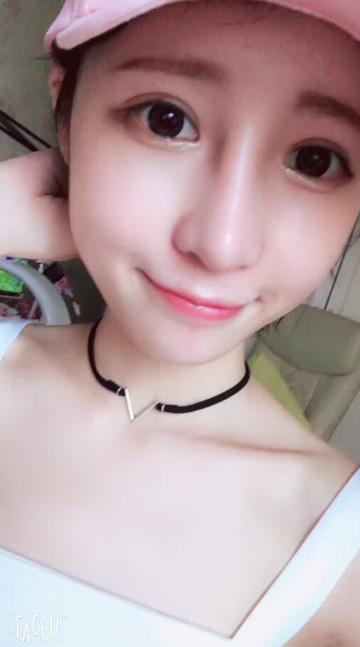 長沙愛思特整形醫(yī)院陳星光醫(yī)生做鼻部多項(xiàng)+自體脂肪隆鼻+切開雙眼皮+開外眼角案例