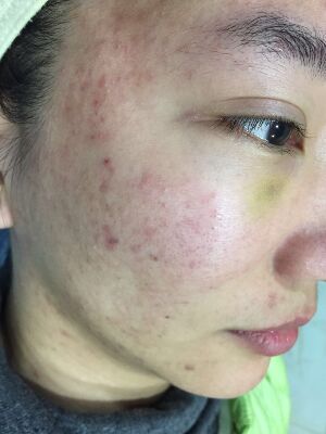 重慶柏漫醫(yī)療美容診所做激光祛痘效果怎么樣？白亞亞激光祛痘案例