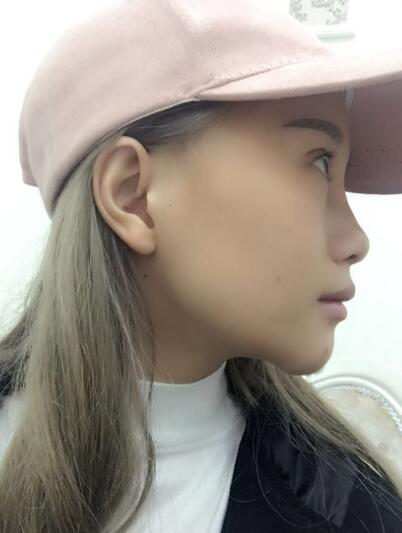 長春奧拉克美容醫(yī)院金相勛醫(yī)生做玻尿酸豐臥蠶怎么樣？附案例