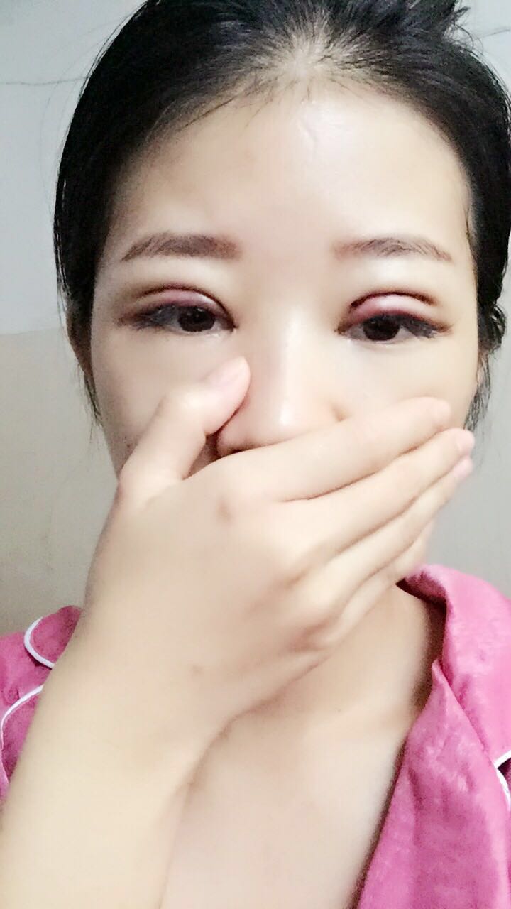 深圳晨曦醫(yī)療整形醫(yī)生吉米斯做切開雙眼皮怎么樣？吉米斯切開雙眼皮案例效果