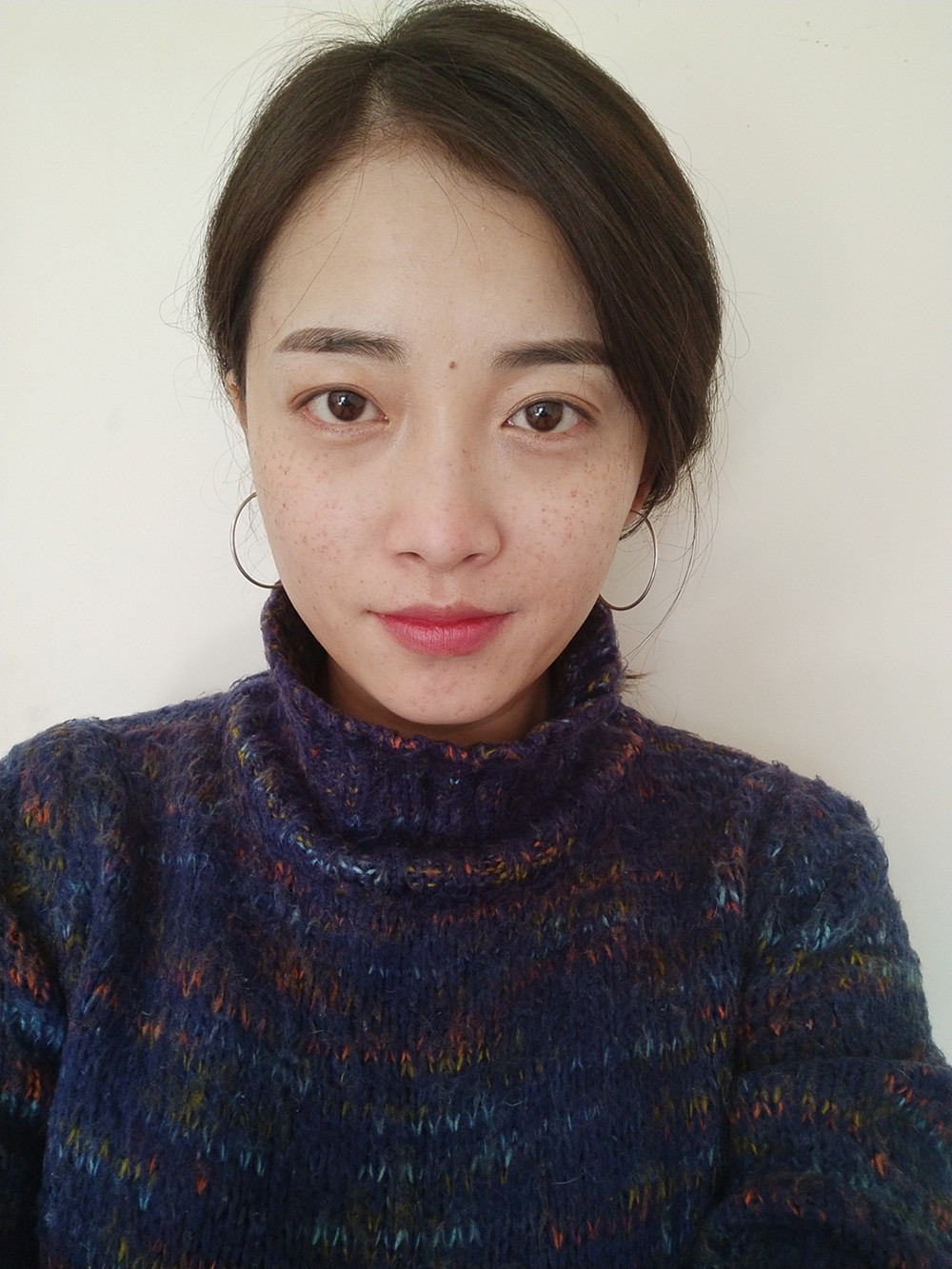 重慶當(dāng)代整形李敏旭醫(yī)生做皮秒激光祛斑效果怎么樣？附皮秒激光祛斑案例