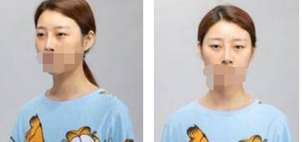 太原歐美蓮整形醫(yī)院丁曉峰醫(yī)生做雙眼皮怎么樣？丁曉峰雙眼皮手術(shù)案例分享