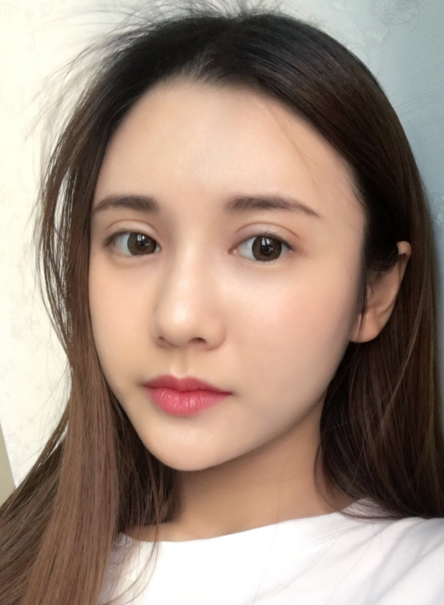 鄭州銘藝整形醫(yī)生陳濤做切開雙眼皮怎么樣？鄭州銘藝切開雙眼皮案例