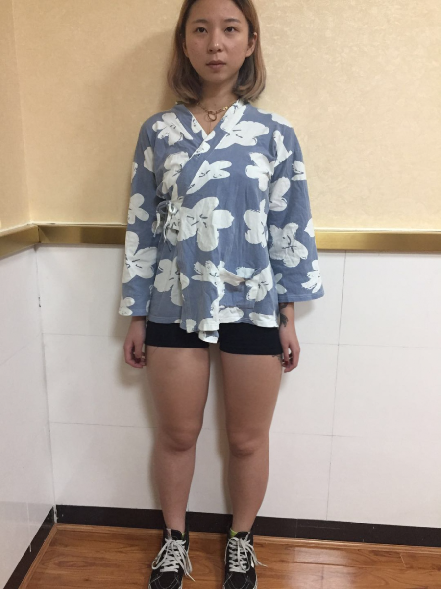 深圳鵬愛(ài)醫(yī)療整形醫(yī)生張建文做大腿吸脂怎么樣？附大腿吸脂案例效果對(duì)比圖