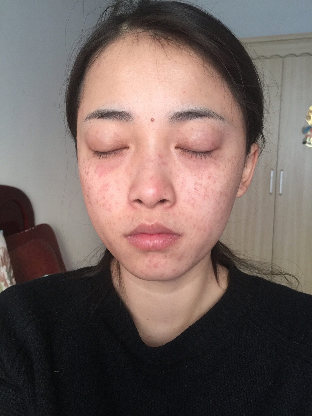 重慶當(dāng)代整形李敏旭醫(yī)生做皮秒激光祛斑效果怎么樣？附皮秒激光祛斑案例