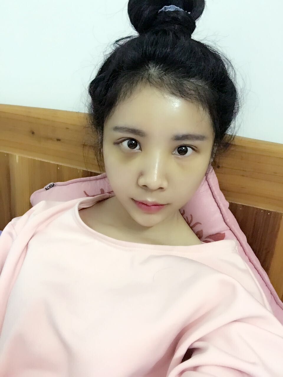 西安高一生醫(yī)療美容醫(yī)院網(wǎng)購(gòu)恒醫(yī)生做自體脂肪全臉填充案例效果對(duì)比圖