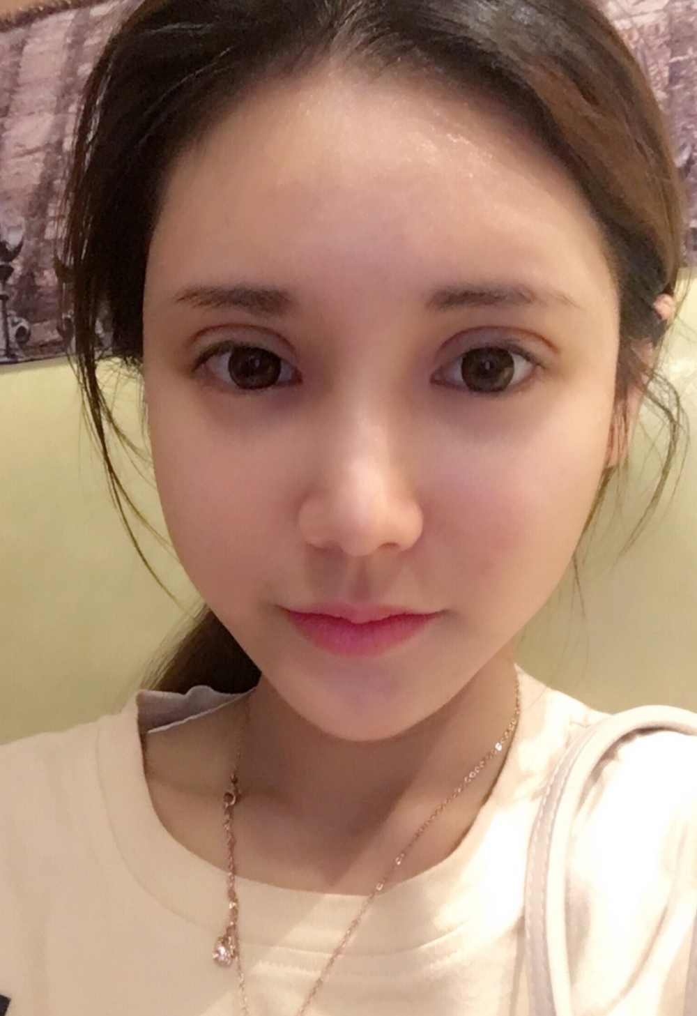 鄭州銘藝整形醫(yī)生陳濤做切開雙眼皮怎么樣？鄭州銘藝切開雙眼皮案例