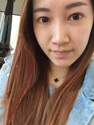 重慶五洲女子醫(yī)院整形美容中心做光子嫩膚怎么樣？淡明斌醫(yī)生光子嫩膚案例
