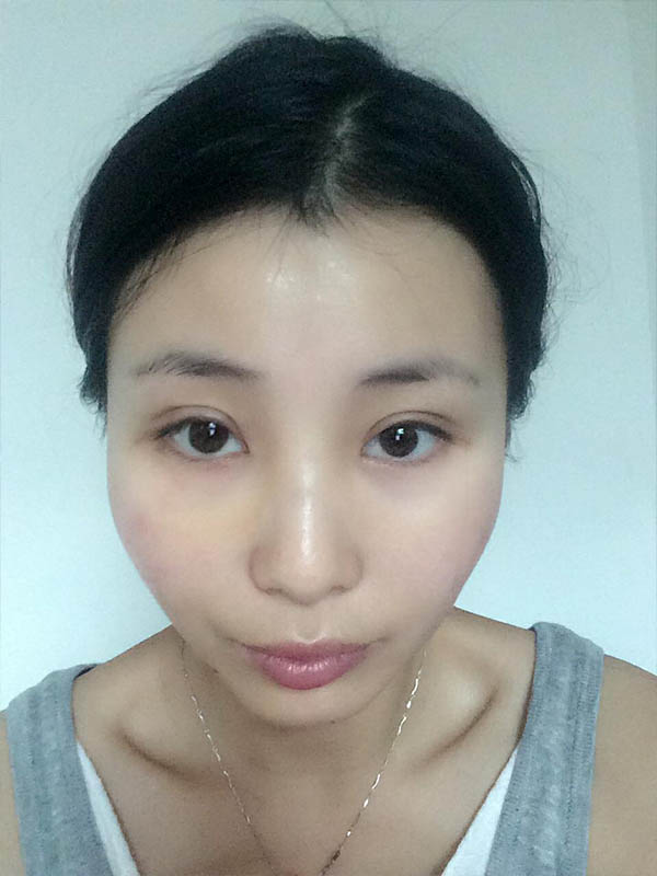 桂林新華醫(yī)療美容醫(yī)生李新華做雙眼皮手術怎么樣？李新華雙眼皮手術案例