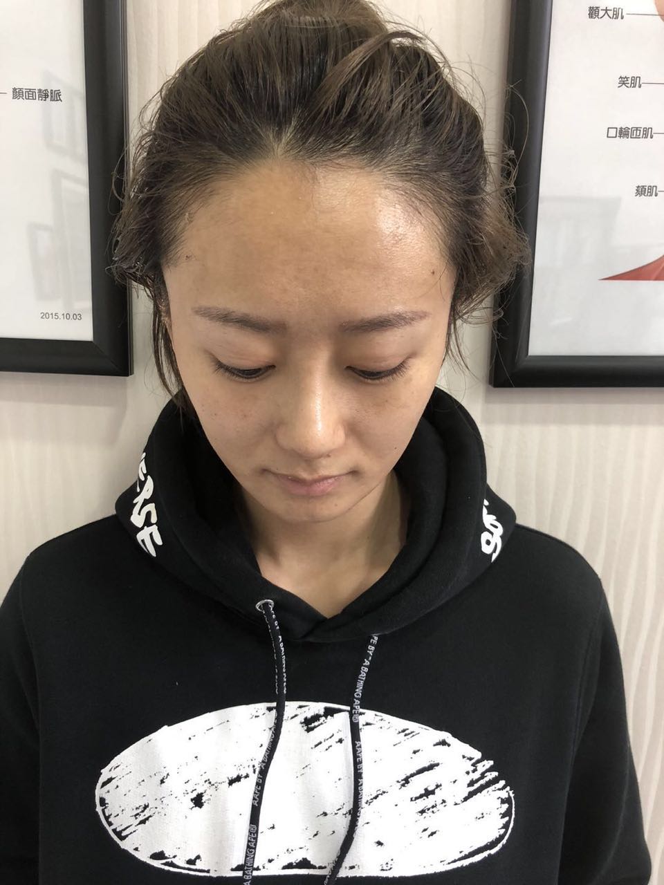 杭州迪美整形常德成醫(yī)生做鼻綜合整形技術(shù)怎么樣？附鼻綜合整形案例