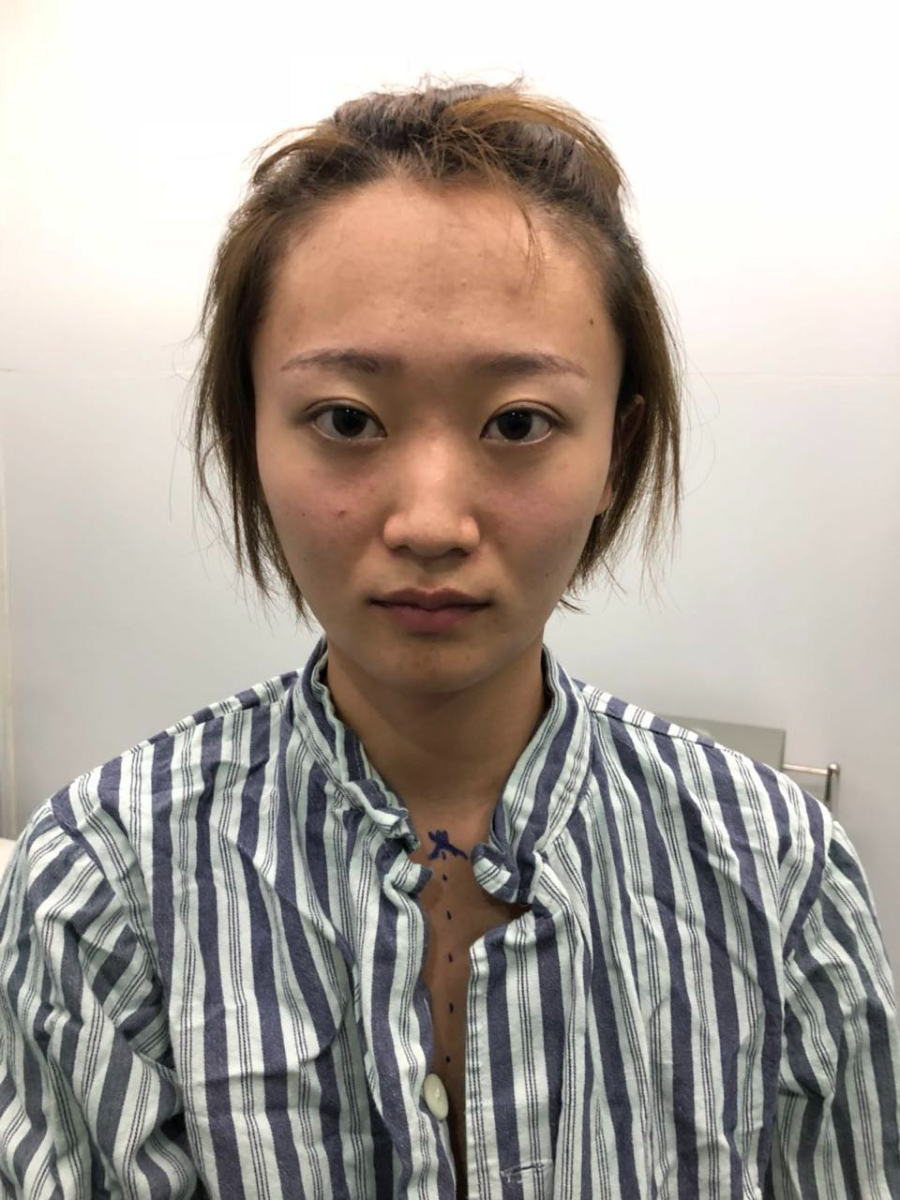 杭州迪美整形常德成醫(yī)生做鼻綜合整形技術怎么樣？附鼻綜合整形案例