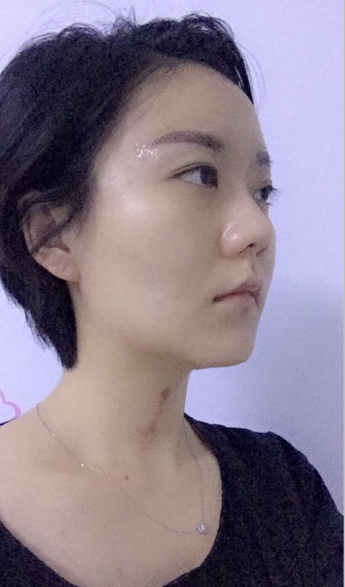 沈陽友誼整形美容醫(yī)院金顕哲醫(yī)生做自體脂肪填充臉部+V-LINE瓜子臉手術案例效果圖