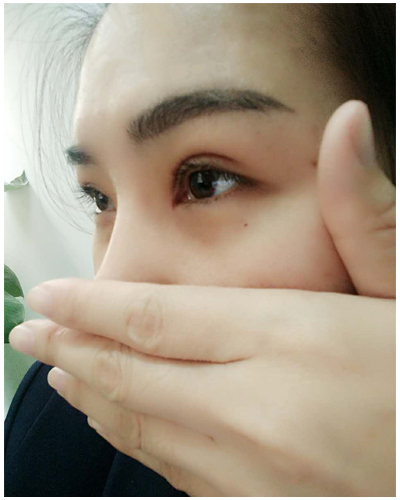 營口臻美醫(yī)療整形醫(yī)生閆迎軍做雙眼皮效果怎么樣？附雙眼皮案例對比圖