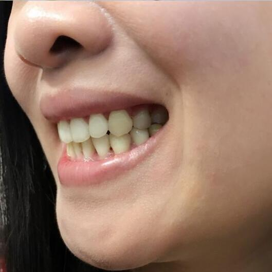重慶嘉悅口腔醫(yī)院周繼祥醫(yī)生做金屬托槽矯正效果怎么樣？附案例效果對比圖