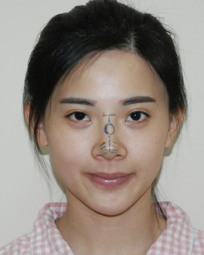 襄陽(yáng)維多利亞整形醫(yī)院安邰晥醫(yī)生做鼻綜合整形怎么樣？附鼻綜合整形案例
