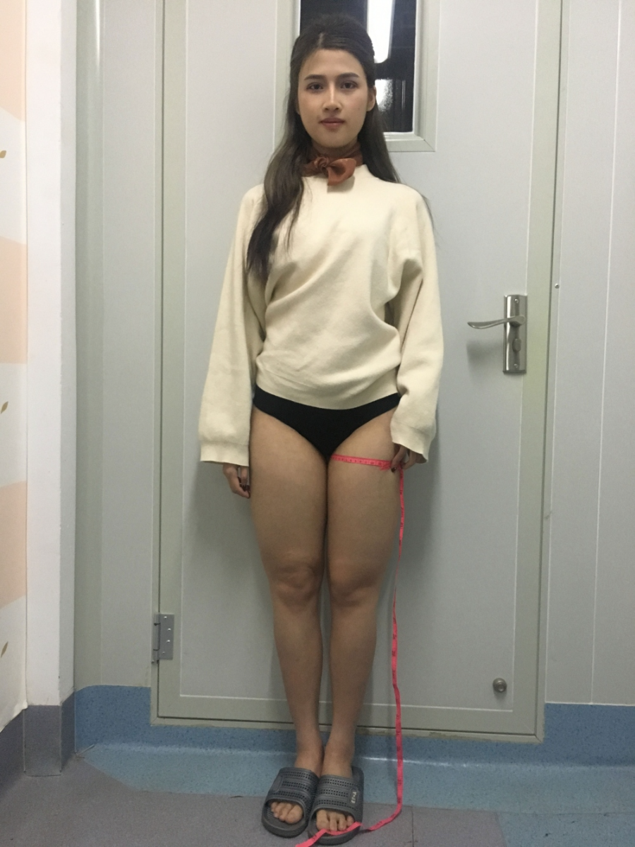 晉城鳳凰整形美容醫(yī)院宋發(fā)興醫(yī)生做大腿吸脂怎么樣？附大腿吸脂案例