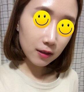 信陽東方藝美容醫(yī)院劉力萌做玻尿酸去法令紋效果怎么樣？附案例效果對(duì)比圖